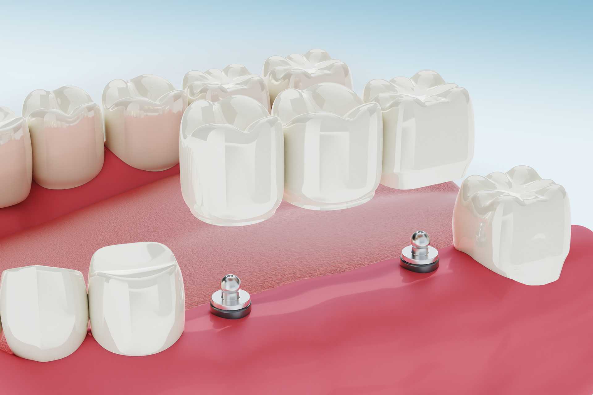 01 Modelo en 3D de una protesis dental triple